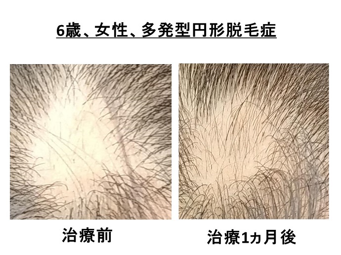 円形脱毛症　病院